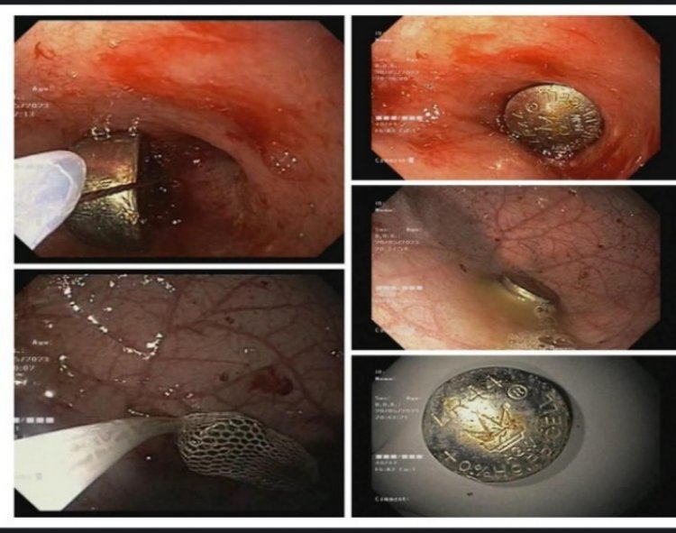 बच्चे की आंत में फंसे कॉइन सेल को स्पर्श अस्पताल के अनुभवी डॉक्टर ने बिना ऑपरेशन के निकाला बाहर
