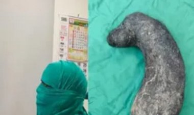 महिला के पेट से निकला ढाई किलो बाल