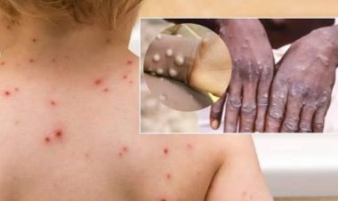 मंकीपॉक्स का खतरा, रायपुर के 19 बच्चे क्वॉरेंटाइन